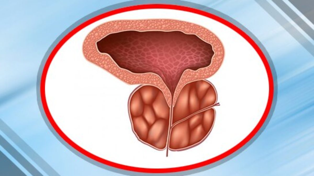 Prostate Hyperplasia 1 foka)