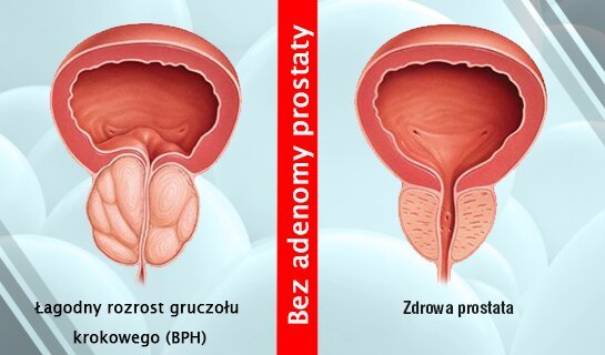 Prostata Leczenie Przerost Gruczołu Krokowego 1 Wrażenie 1243